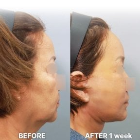 before-after photo facial-fat-transfer