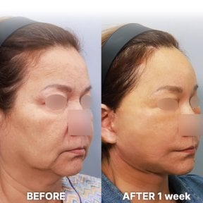 before-after photo facial-fat-transfer