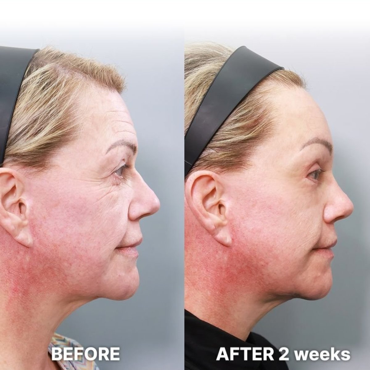 Resultados de transferencia de grasa facial antes y después en Returning Plastic Surgery, 2 semanas