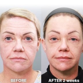 before-after photo facial-fat-transfer