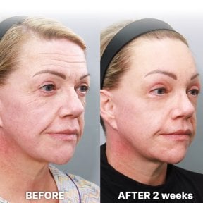 before-after photo facial-fat-transfer