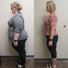 before-after photo ballonirovanie