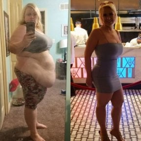 before-after photo ballonirovanie