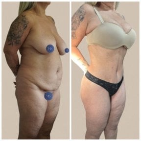 before-after photo abdominal-liposuction