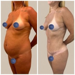 before-after photo tummy-tuck-and-liposuction