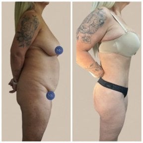 before-after photo tummy-tuck-and-liposuction