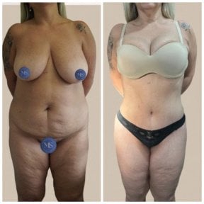 before-after photo tummy-tuck-and-liposuction