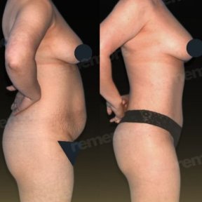 before-after photo tummy-tuck-and-liposuction