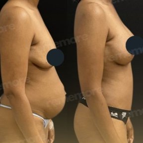 before-after photo tummy-tuck-and-liposuction