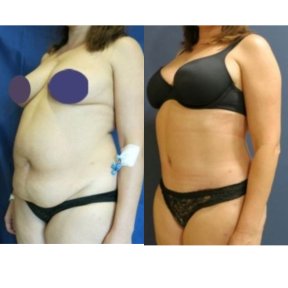 before-after photo mommy-makeover