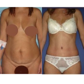 before-after photo mommy-makeover