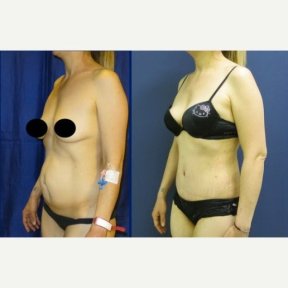before-after photo mommy-makeover
