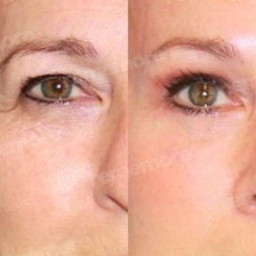 before-after photo lower-eyelid-surgery