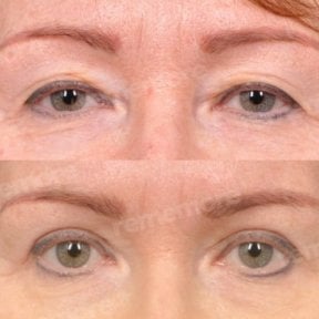 before-after photo lower-eyelid-surgery