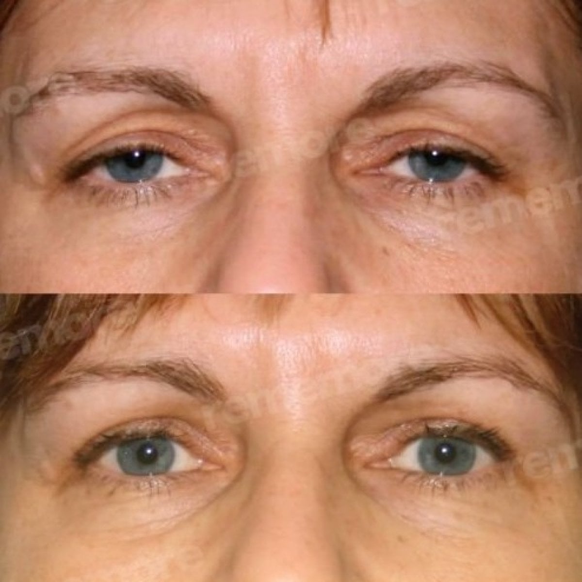 Resultados de blefaroplastia de párpado inferior antes y después en Memorial Antalya Hospital