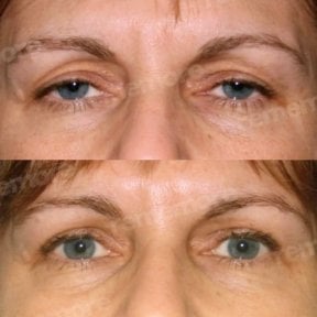 before-after photo lower-eyelid-surgery