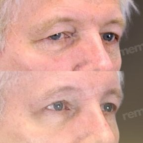 before-after photo lower-eyelid-surgery