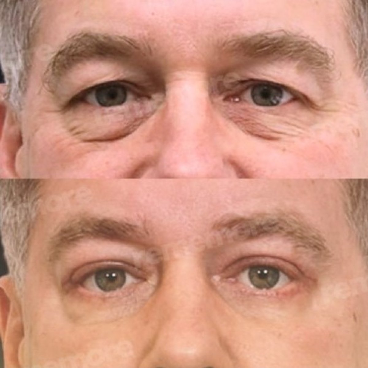 Resultados de blefaroplastia de párpado inferior antes y después en Memorial Antalya Hospital