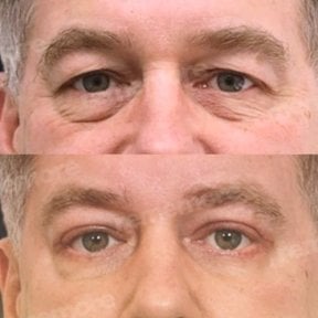 before-after photo lower-eyelid-surgery