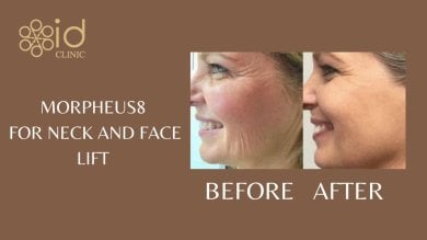 before-after photo mommy-makeover