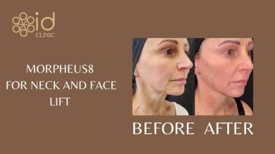 before-after photo mommy-makeover