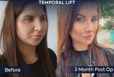 before-after photo facial-fat-transfer