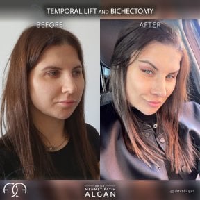 before-after photo facial-fat-transfer