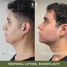 before-after photo facial-fat-transfer