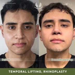 before-after photo facial-fat-transfer