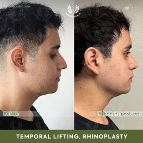 before-after photo facial-fat-transfer