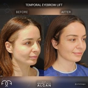 before-after photo facial-fat-transfer