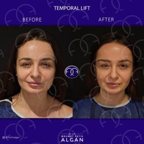 before-after photo facial-fat-transfer