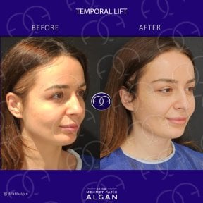 before-after photo facial-fat-transfer