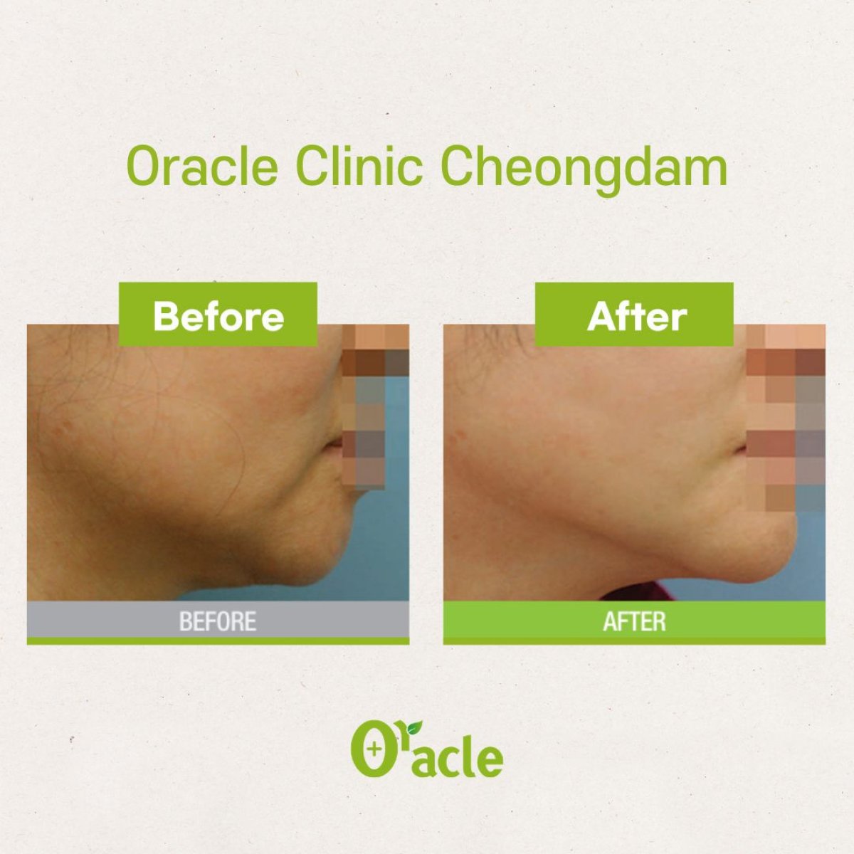 نتائج قبل وبعد تقشير البشرة بالليزر في Oracle Clinic Cheongdam، خط فك أنعم