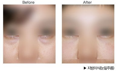 Before and after facial fat transfer under eyes at HERSHE Plastic Surgery Korea, visible result