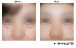 Before and after facial fat transfer under eyes at HERSHE Plastic Surgery Korea, visible result
