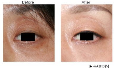 نتيجة نقل الدهون للوجه تحت العين في HERSHE Plastic Surgery Korea قبل وبعد