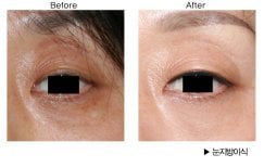 نتيجة نقل الدهون للوجه تحت العين في HERSHE Plastic Surgery Korea قبل وبعد