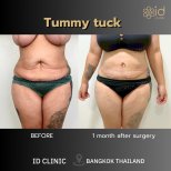 Before and after tummy tuck results at ID Clinic Bangkok – visible abdominal contour improvement