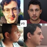 Resultados de rinoplastia antes y después en VG Plastic Surgery, mejora de la forma nasal