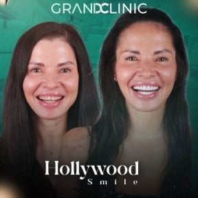 Голливудская улыбка до и после в Grand Clinic – заметное преображение улыбки