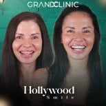 Голливудская улыбка до и после в Grand Clinic – заметное преображение улыбки