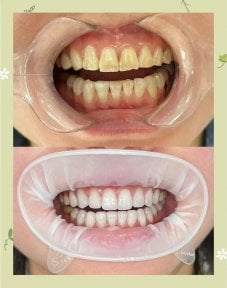 Before and after veneers at Xiamen Humanity Hospital – smile makeover with natural results