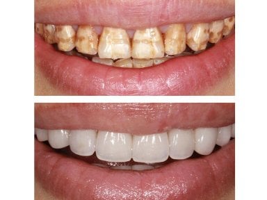 Before and after veneers at Xiamen Humanity Hospital – smile makeover with natural results