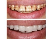 Before and after veneers at Xiamen Humanity Hospital – smile makeover with natural results