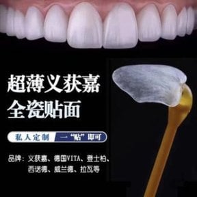 Ultra-thin dental veneers result at Xiamen Humanity Hospital – natural smile transformation