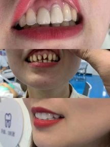 Before and after dental veneers at Xiamen Humanity Hospital, smile transformation results