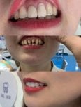 Before and after dental veneers at Xiamen Humanity Hospital, smile transformation results