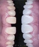 Before and after veneers result at Xiamen Humanity Hospital, whiter and even smile transformation