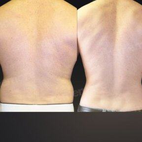 before-after photo liposakciya